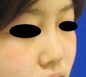 術後　右前斜位